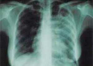 В Шотландии обнаружена новая разновидность туберкулеза