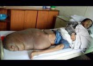 У китайца на ноге выросла опухоль весом 70 кг