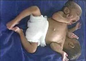 В Кении в течение месяца родились две пары сиамских близнецов