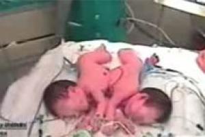 Испанские врачи разделили сиамских близнецов из Марокко