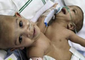 В Саудовской Аравии врачи разделяли сиамских близнецов