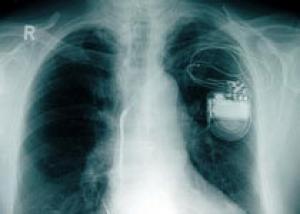 Ученые создали кардиостимулятор, который заряжается от сердца