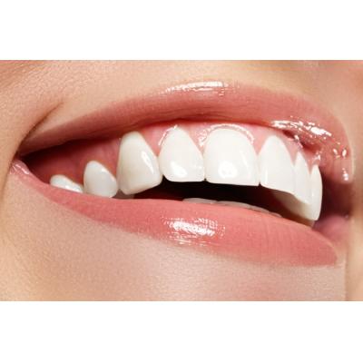 Стоматологи рассказали про самые передовые способы отбеливания зубов