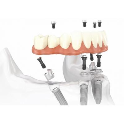 Протокол All-on-4: имплантация в стоматологическом центре «Зууб»