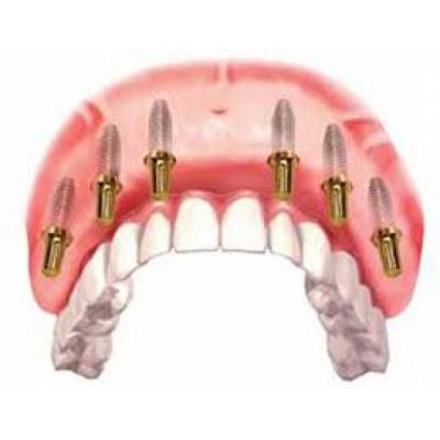 «All-on-6»: новая услуга восстановления зубов в стоматологии «Зууб»