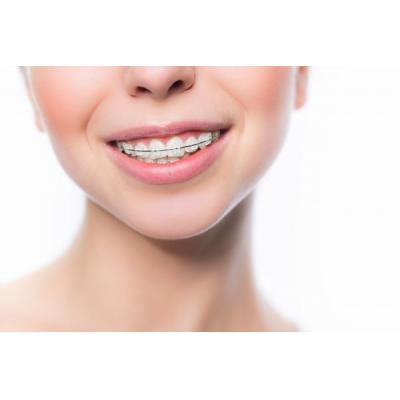 Акцию по установке сапфировых брекетов запускает стоматологический центр «Зууб»