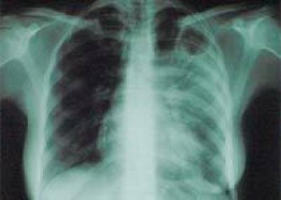 Итальянские власти всерьез озабочены случаем в больным туберкулезом мужчиной