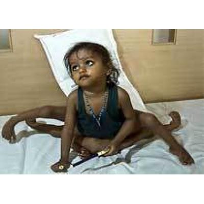 Индийские хирурги прооперируют девочку с восемью конечностями