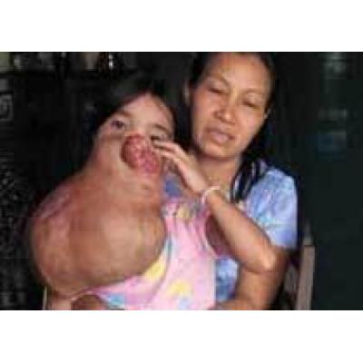 Врачи спасают 15-летнюю вьетнамку от семикилограммовой опухоли