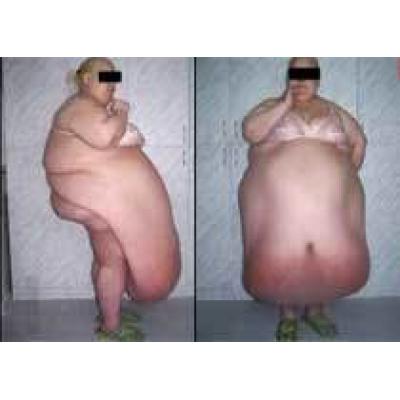Воронежские врачи удалили женщине живот весом 57 кг