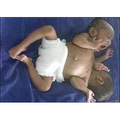 В Кении в течение месяца родились две пары сиамских близнецов