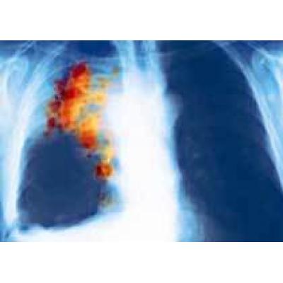 Ученые объяснили связь между курением и раком легких