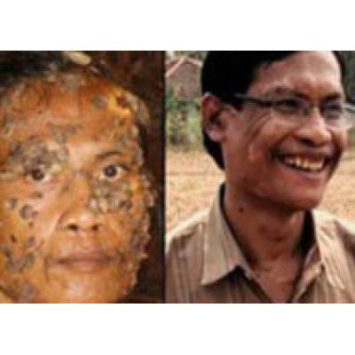 Индонезийский человек-дерево поборол свою болезнь