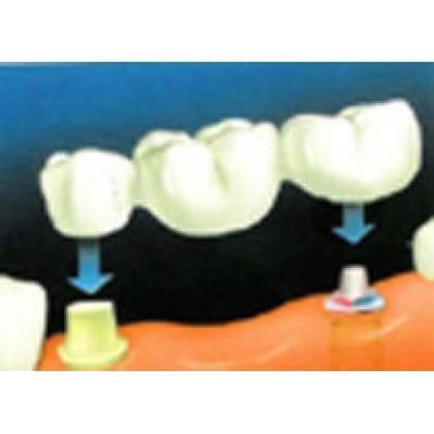Имплантация зубов с помощью лазера не фантастика