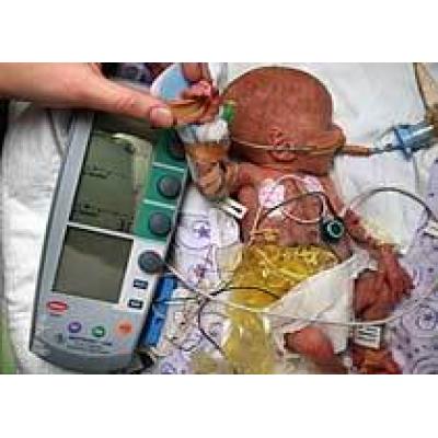 Австралийские врачи установили кардиостимулятор новорожденной весом в полкилограмма