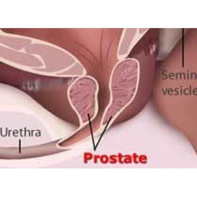 Американские ученые выявили причину рака простаты