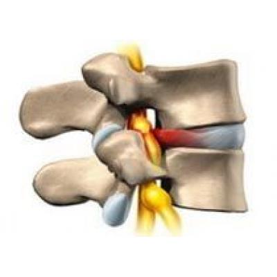 Грыжа межпозвонкового диска, симптоматика, лечение