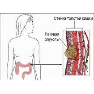 С раком толстой кишки можно бороться с помощью болеутоляющих средств