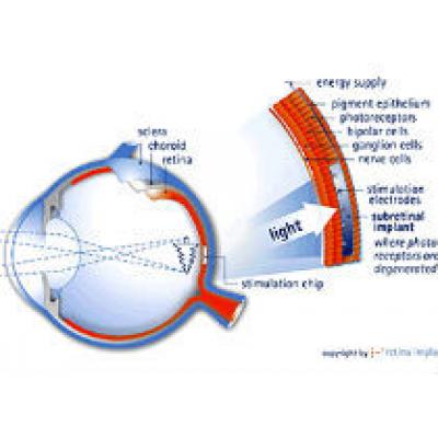 Создан глазной имплантат, помогающий вернуть зрение
