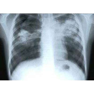 Туберкулез: право на жизнь и здоровье