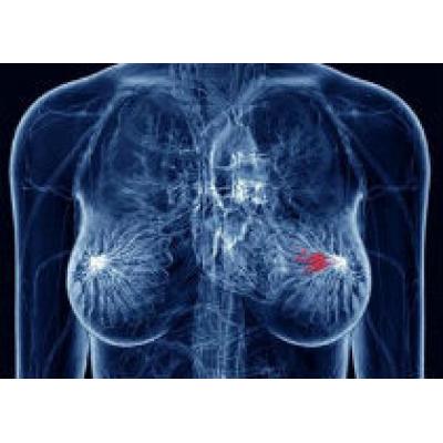 Найден самый эффективный метод лечения рака груди