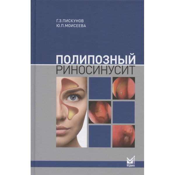 Полипозный риносинусит